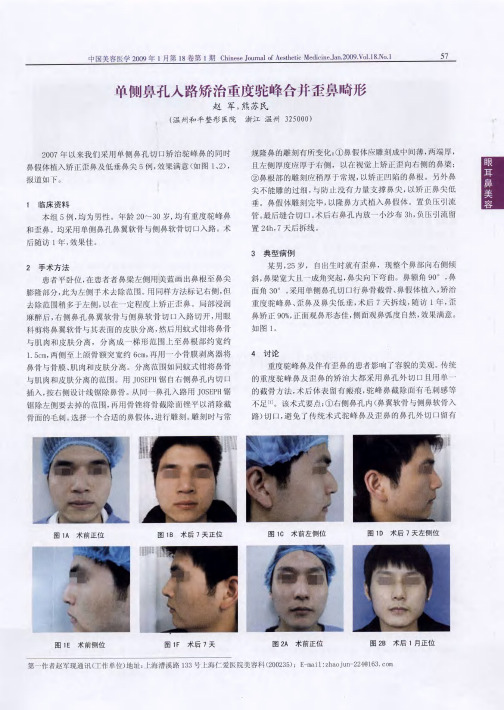 单侧鼻孔入路矫治重度驼峰合并歪鼻畸形