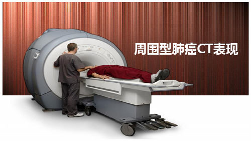 周围型肺癌CT表现
