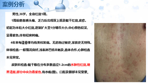 多形红斑