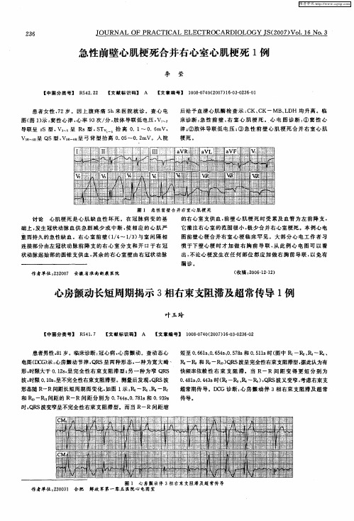心房颤动长短周期揭示3相右束支阻滞及超常传导1例