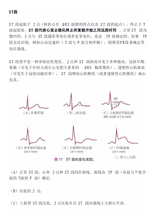 ST段、QT间期、T.U波-基础心电图讲解
