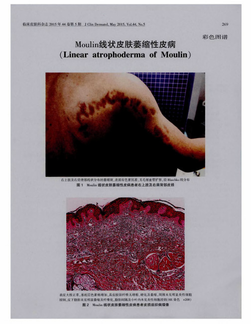 Moulin线状皮肤萎缩性皮病