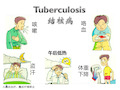 《病理学》结核病