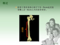 股骨干骨折的护理PPT课件