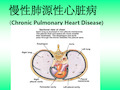 肺心病的护理PPT课件