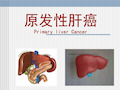 原发性肝癌99282 PPT课件
