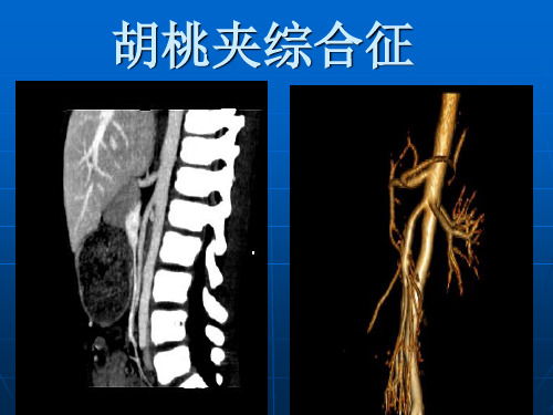 胡桃夹综合征