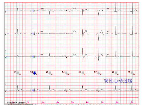 心电图常见正常和异常心电图图谱ppt课件