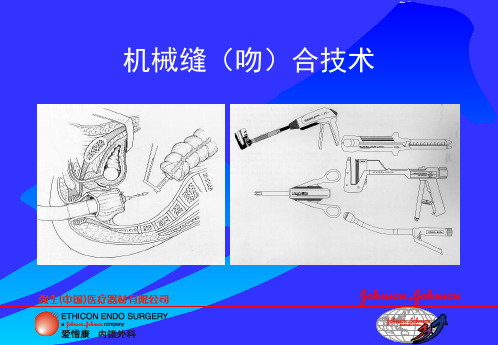 机械缝(吻)合技术