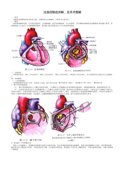 (仅供参考)法洛四联症讲解,及手术图解