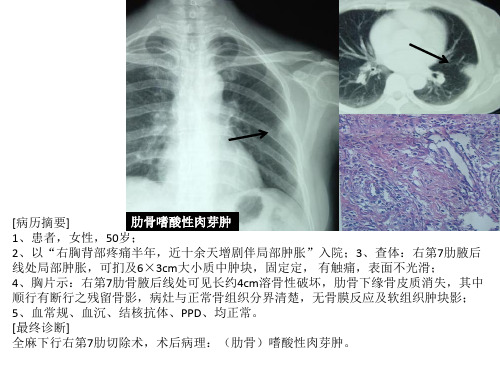 少见病例：肋骨嗜酸性肉芽肿