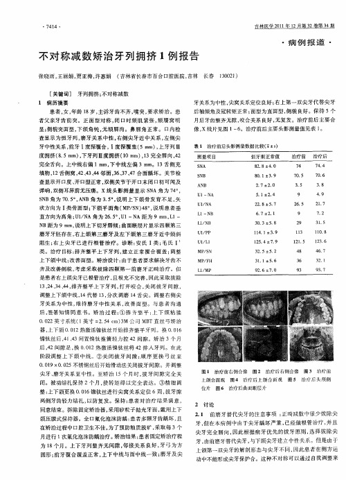 不对称减数矫治牙列拥挤1例报告