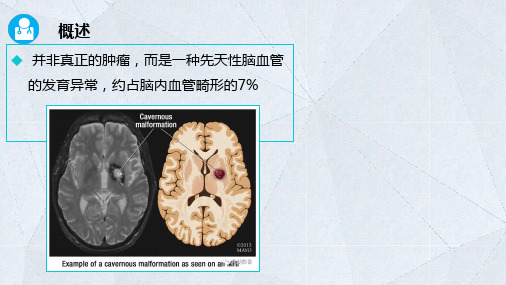 112海绵状血管瘤医学影像学