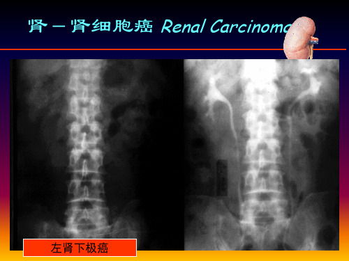 肾脏病变影像诊断3