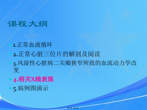 风湿性心脏病二尖瓣狭窄X线表现