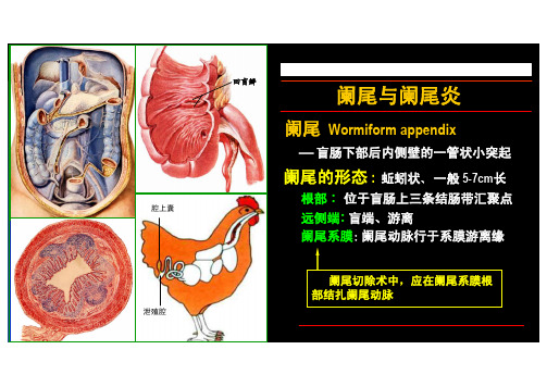 阑尾与阑尾炎(左图)