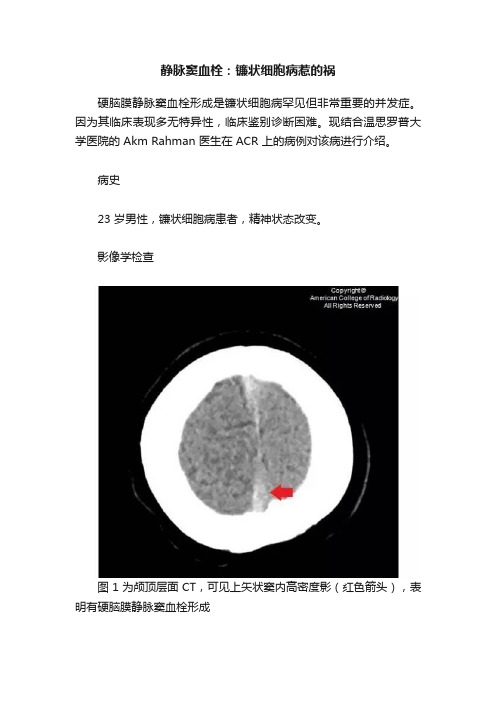 静脉窦血栓：镰状细胞病惹的祸