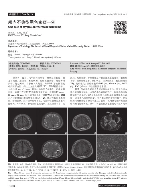 颅内不典型黑色素瘤一例