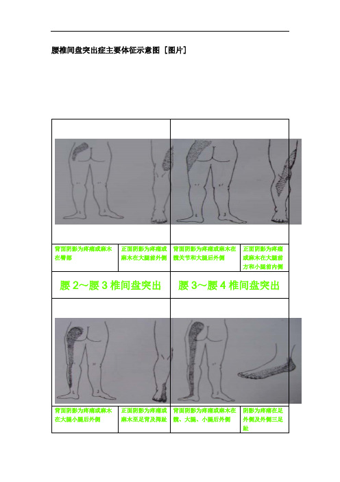 腰椎间盘突出症主要体征示意图