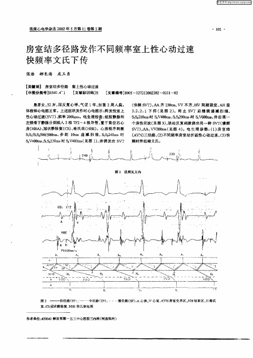 房室结多径路发作不同频率室上性心动过速快频率文氏下传