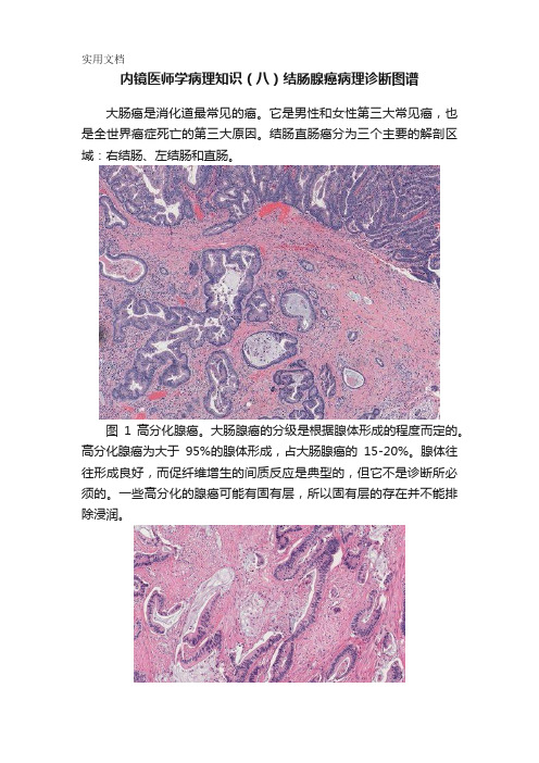 内镜医师学病理知识(八)结肠腺癌病理诊断图谱