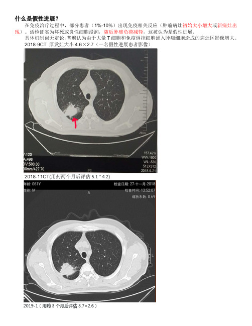 肿瘤免疫治疗假性进展判断(精).doc