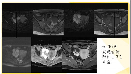 卵巢畸胎瘤的CT、MR表现【影像科】 ppt课件