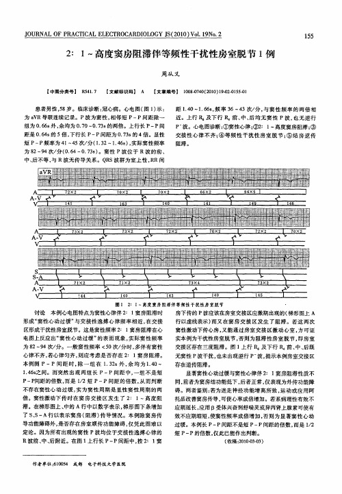 2∶1～高度窦房阻滞伴等频性干扰性房室脱节1例