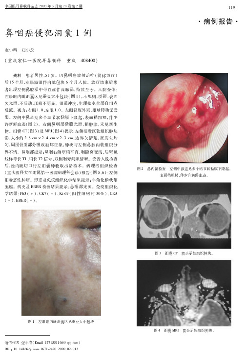 鼻咽癌侵犯泪囊1例