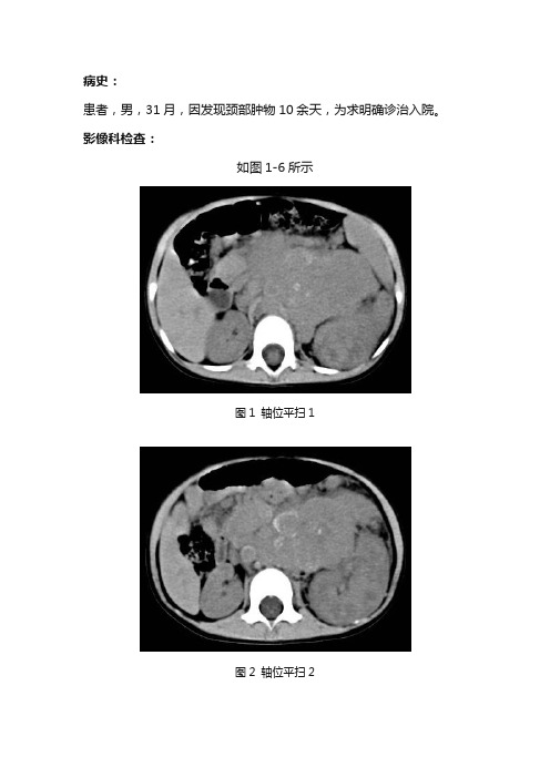 小儿腹膜后神经母细胞瘤CT诊断与鉴别诊断