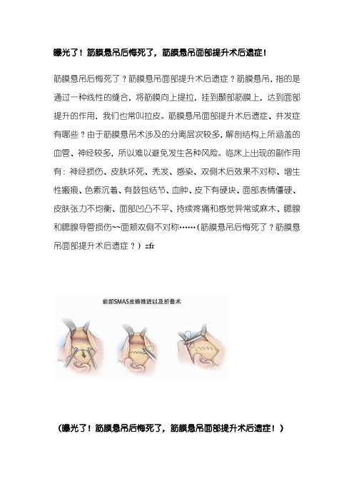 曝光了!筋膜悬吊后悔死了,筋膜悬吊面部提升术后遗症!