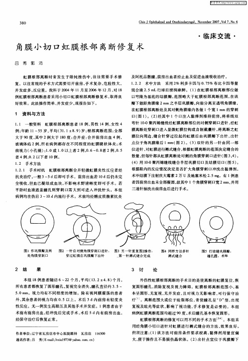 角膜小切口虹膜根部离断修复术