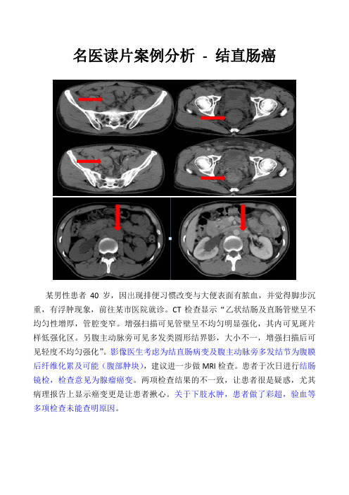 名医读片案例分享_CT腹部_结直肠癌