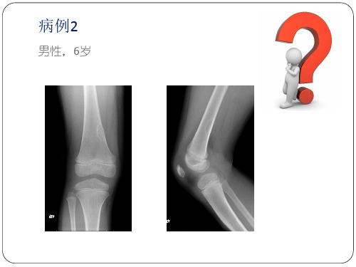 非骨化性纤维瘤的x线诊断及鉴别诊断ppt课件