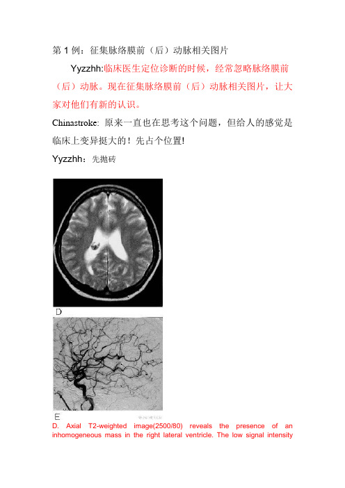 脉络膜前动脉