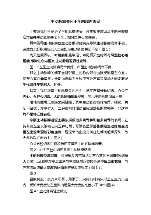 主动脉瓣关闭不全的超声表现