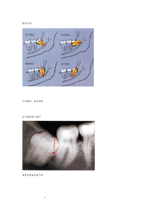 拔牙技巧图解