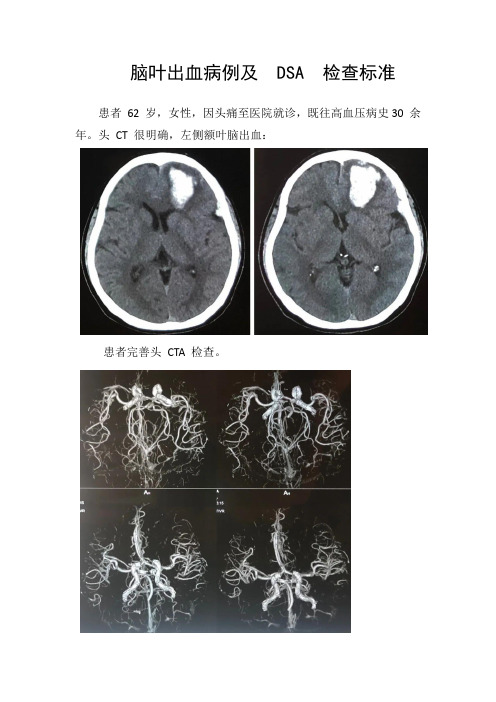 脑叶出血病例及DSA检查标准