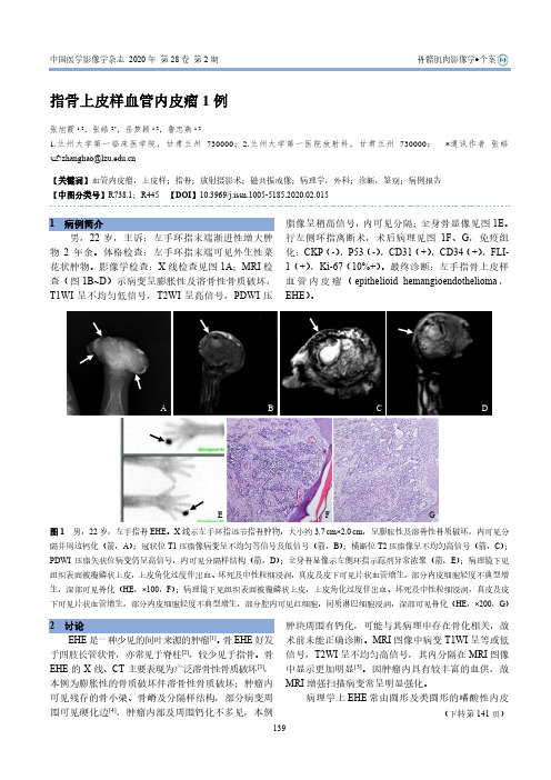 指骨上皮样血管内皮瘤1例
