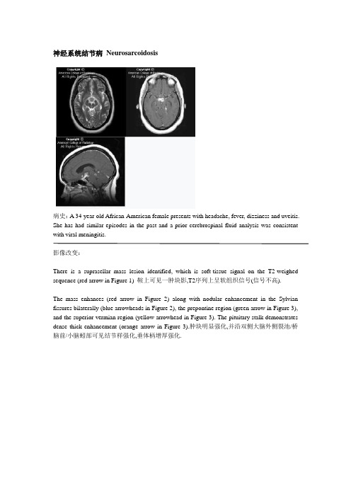 神经系统结节病 Neurosarcoidosis