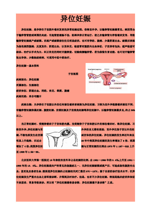 异位妊娠(同名4732)