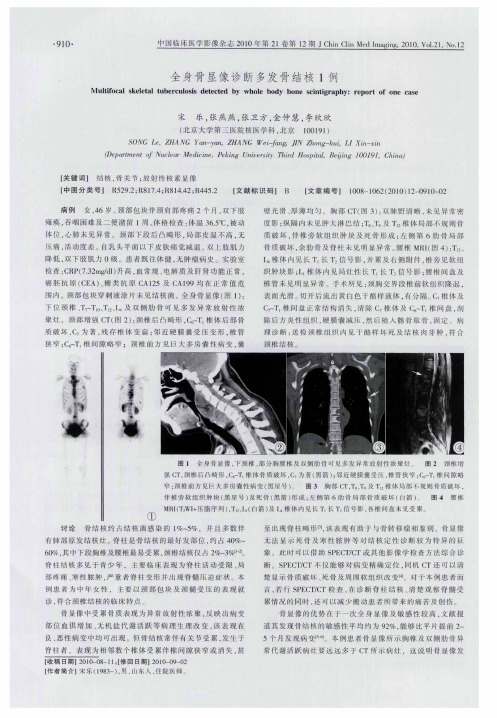 全身骨显像诊断多发骨结核1例