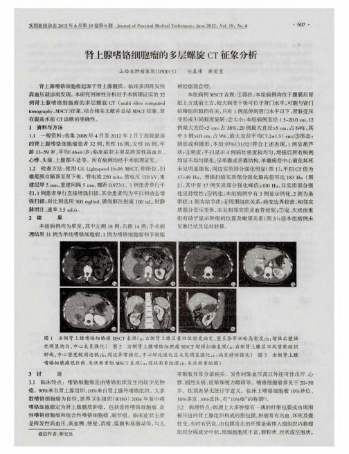 肾上腺嗜铬细胞瘤的多层螺旋CT征象分析