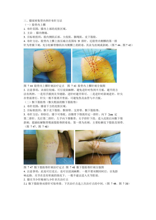 内热针布针方法(三)