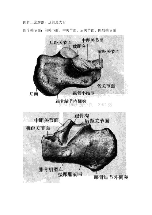 跟骨骨折