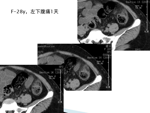 腹腔炎性脂肪性肿块的鉴别诊断