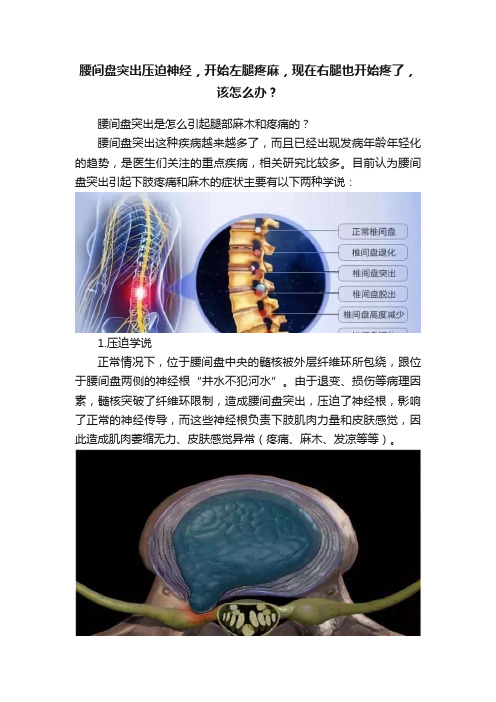 腰间盘突出压迫神经，开始左腿疼麻，现在右腿也开始疼了，该怎么办？