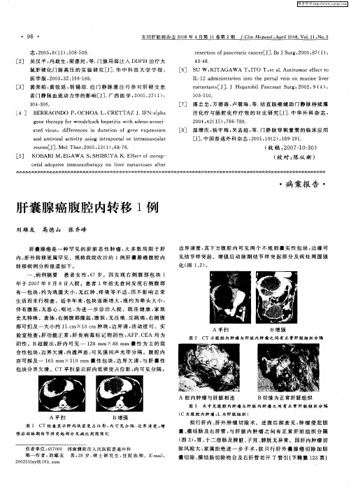 肝囊腺癌腹腔内转移1例