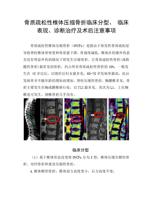 骨质疏松性椎体压缩骨折临床分型、 临床表现、诊断治疗及术后注意事项