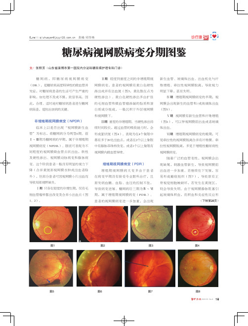 糖尿病视网膜病变分期图鉴